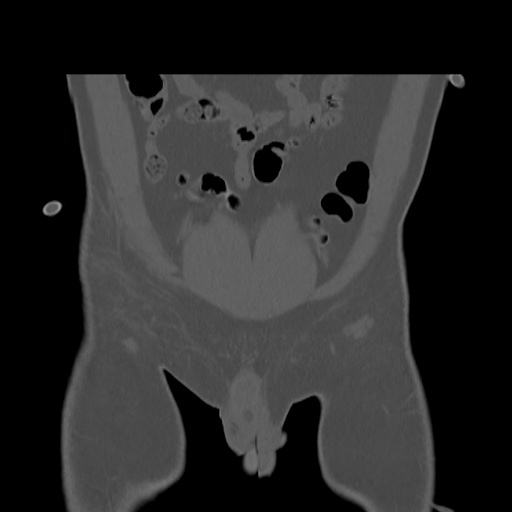 Acetabular and ilial fractures (Radiopaedia 59084-66378 Coronal bone window 3).jpg