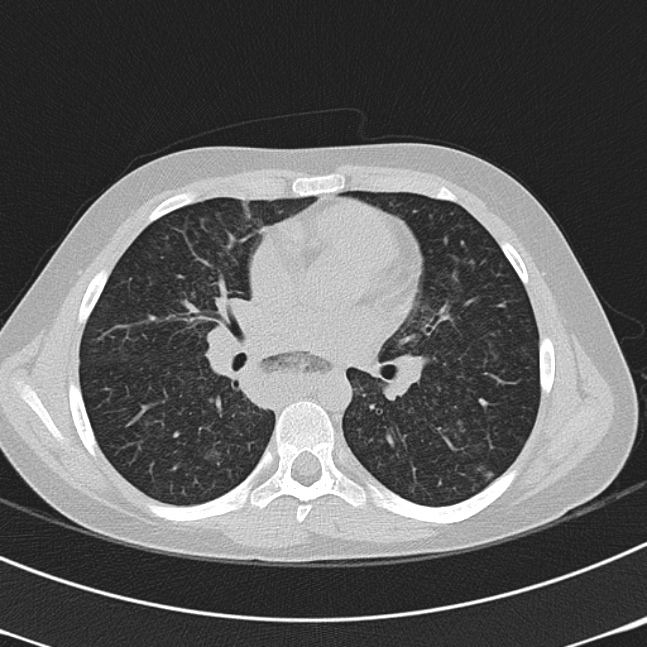 Achalasia (Radiopaedia 14946-14878 Axial lung window 39).jpg