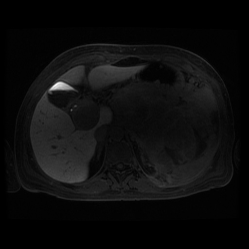 Acinar cell carcinoma of the pancreas (Radiopaedia 75442-86668 Axial late phase (~30 mins) 84).jpg