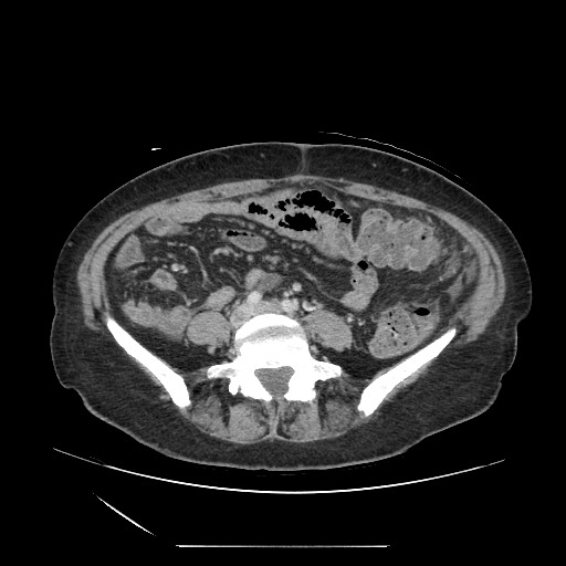 Acinar cell carcinoma of the pancreas (Radiopaedia 75442-86669 Axial C+ portal venous phase 95).jpg