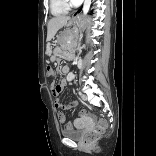 Acinar cell carcinoma of the pancreas (Radiopaedia 75442-86669 Sagittal C+ portal venous phase 108).jpg