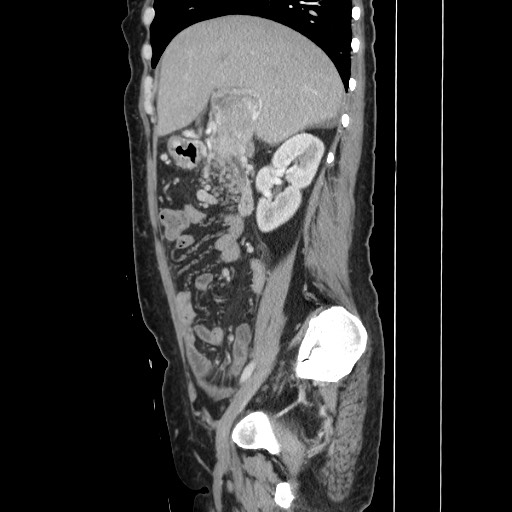 File:Acinar cell carcinoma of the pancreas (Radiopaedia 75442-86669 Sagittal C+ portal venous phase 71).jpg