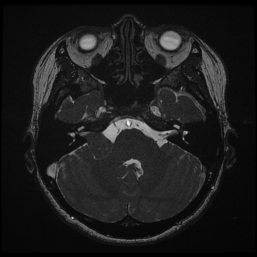 Acoustic neuroma (Radiopaedia 34049-35283 Axial 54).png