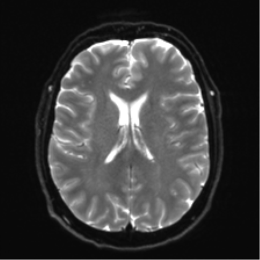 File:Acoustic schwannoma (Radiopaedia 50846-56358 Axial DWI 18).png