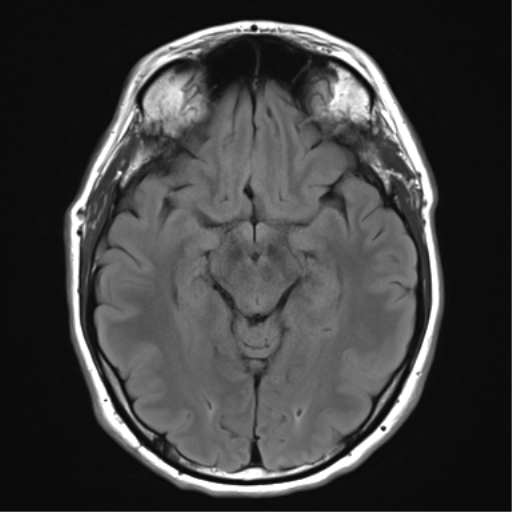 File:Acoustic schwannoma (Radiopaedia 50846-56358 Axial FLAIR 14).png