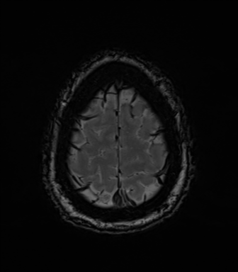 Acoustic schwannoma (Radiopaedia 50846-56358 Axial SWI 84).png