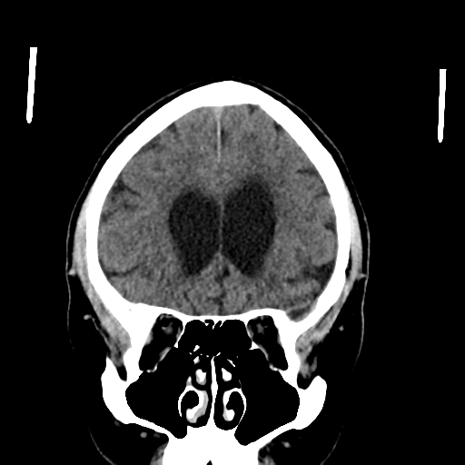 File:Acoustic schwannoma (Radiopaedia 55729-62280 Coronal non-contrast 14).png