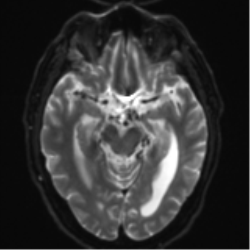 File:Acoustic schwannoma (Radiopaedia 55729-62281 E 10).png