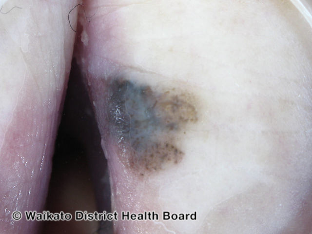 File:Acral lentiginous melanoma dermoscopy (DermNet NZ alm-dermoscopy-3).jpg