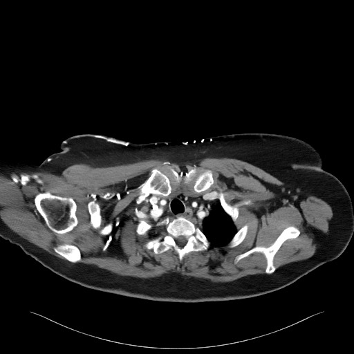 Acromioclavicular joint cyst (Radiopaedia 58455-65610 Axial C+ arterial phase 24).jpg