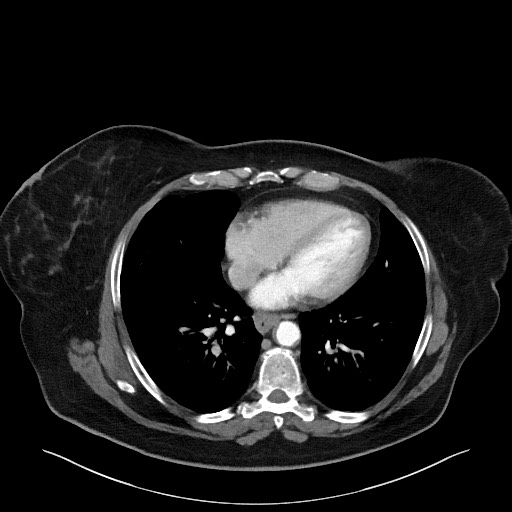 Acromioclavicular joint cyst (Radiopaedia 58455-65610 Axial C+ arterial phase 71).jpg