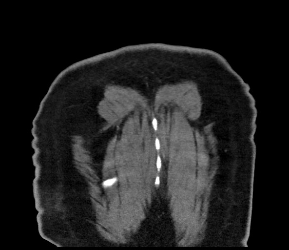 File:Acromioclavicular joint cyst (Radiopaedia 58455-65610 Coronal 112).jpg