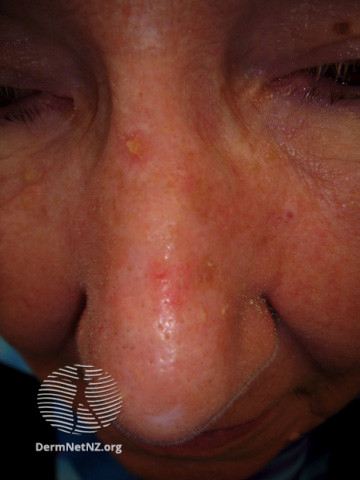 Actinic Keratoses affecting the face (DermNet NZ lesions-ak-face-292).jpg