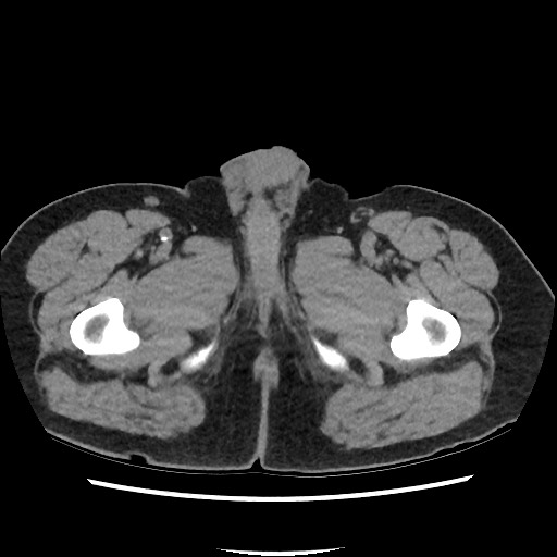 Active colonic bleed on CT (Radiopaedia 49765-55025 Axial non-contrast 93).jpg