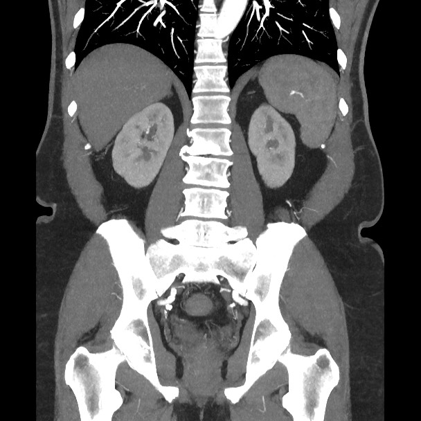 Active colonic bleed on CT (Radiopaedia 49765-55025 Coronal art MIP 43).jpg