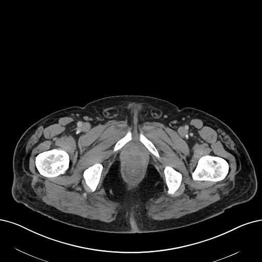 File:Active lower gastrointestinal bleeding - diverticular (Radiopaedia 61203-69106 Axial C+ portal venous phase 136).jpg
