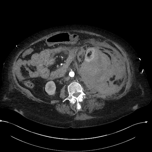 Active renal extravasation with large subcapsular and retroperitoneal hemorrhage (Radiopaedia 60975-68796 Axial C+ arterial phase 96).jpg