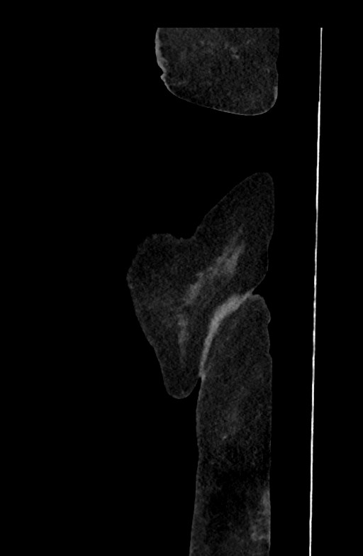 Active renal extravasation with large subcapsular and retroperitoneal hemorrhage (Radiopaedia 60975-68796 Sagittal C+ portal venous phase 221).jpg