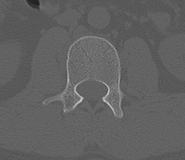 File:Acute L1 burst compression fracture (Radiopaedia 34430-35755 Axial bone window 33).png