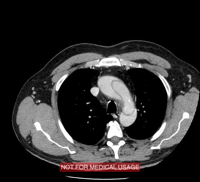 Acute aortic dissection - Stanford type A (Radiopaedia 40661-43285 Axial C+ portal venous phase 5).jpg
