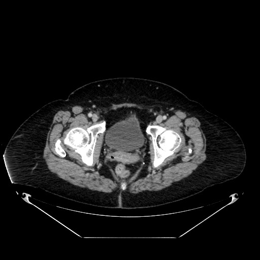 Acute appendicitis, heterotaxy syndrome (Radiopaedia 66884-76202 Axial C+ portal venous phase 124).jpg