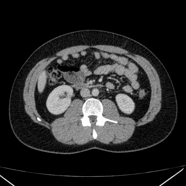 Acute appendicitis (Radiopaedia 38255-40270 Axial C+ portal venous phase 49).jpg