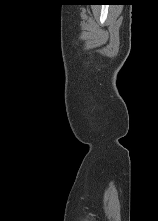 Acute appendicitis (Radiopaedia 48511-53463 Sagittal C+ portal venous phase 12).jpg