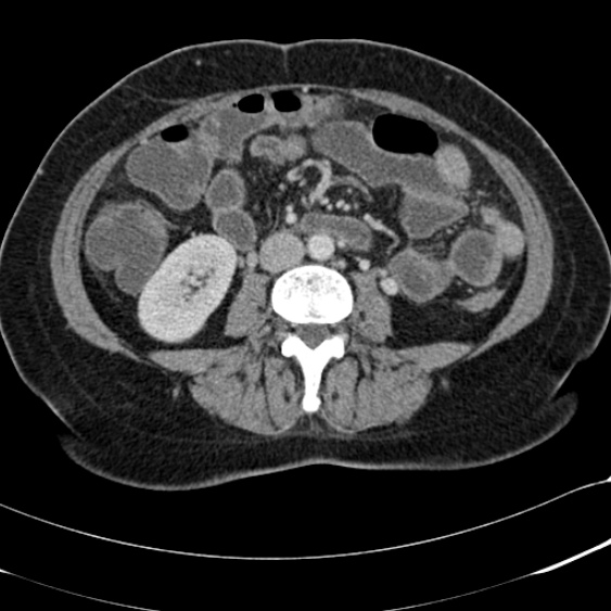File:Acute appendicitis (Radiopaedia 48792-53822 Axial C+ portal venous phase 61).jpg