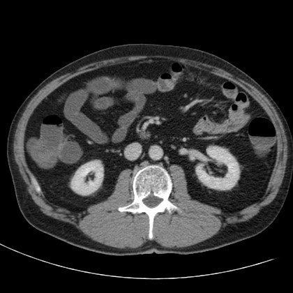 Acute appendicitis (Radiopaedia 66513-75790 Axial C+ portal venous phase 32).jpg