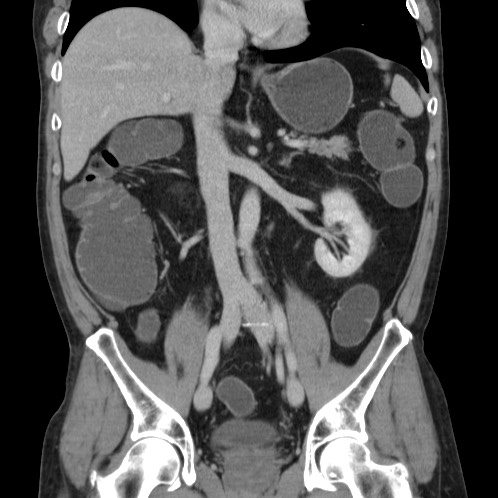 Acute appendicitis (Radiopaedia 66513-75790 Coronal C+ portal venous phase 41).jpg