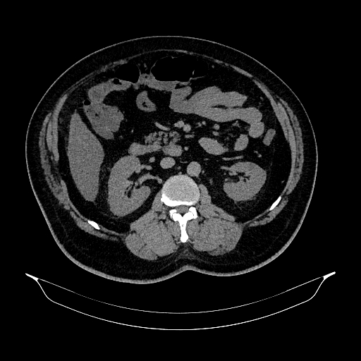 Acute appendicitis (Radiopaedia 79950-93224 Axial non-contrast 45).jpg