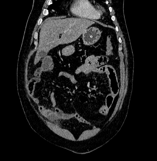 Acute appendicitis (Radiopaedia 79950-93224 Coronal C+ portal venous phase 21).jpg