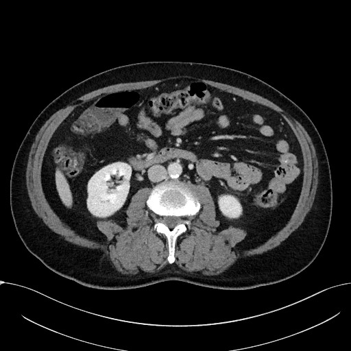 Acute appendicitis - large appendicoliths (Radiopaedia 61805-69820 Axial C+ portal venous phase 64).jpg