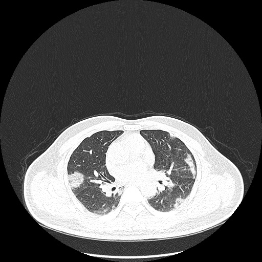 Acute appendicitis and COVID 19 pneumonia (Radiopaedia 76604-88380 Axial lung window 27).jpg