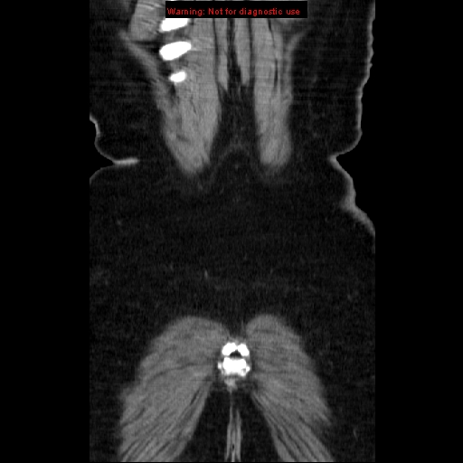 File:Acute appendicitis complicated by ovarian vein thrombophlebitis (Radiopaedia 16172-15851 Coronal C+ portal venous phase 79).jpg