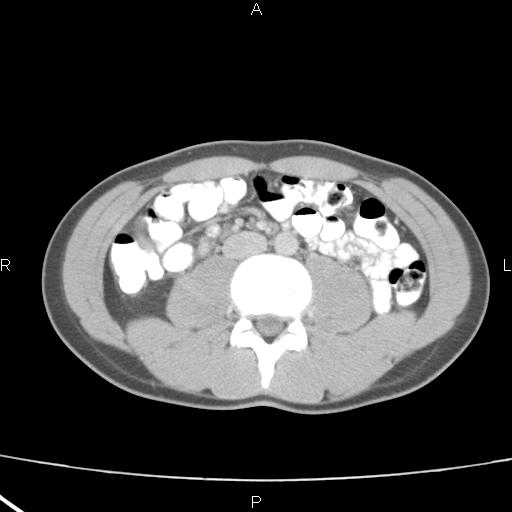File:Acute appendicitis with CT arrowhead sign (Radiopaedia 21474-21411 Axial C+ portal venous phase 21).jpg