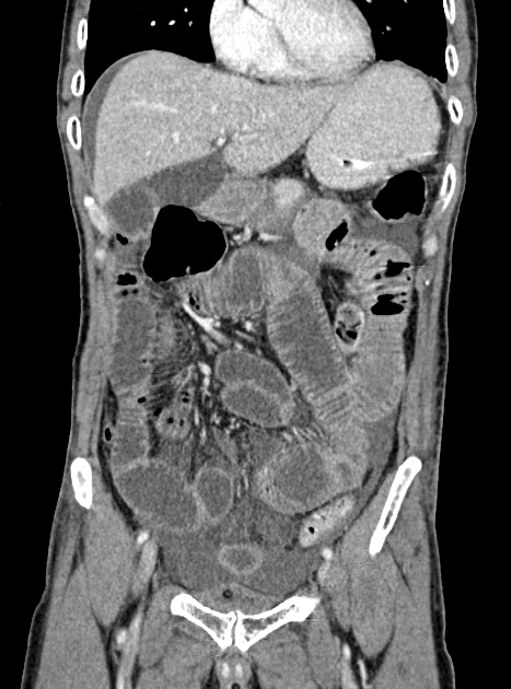 Acute bowel ischemia (Radiopaedia 87695-104114 Coronal C+ portal venous phase 159).jpg