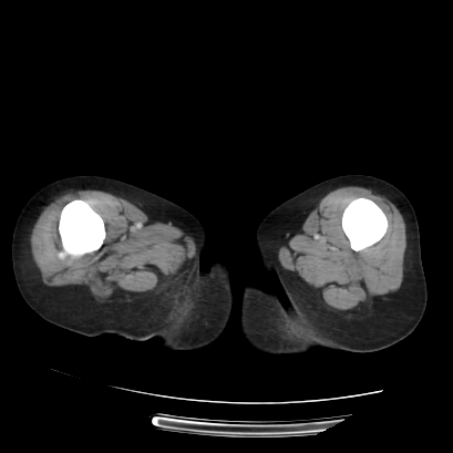 Acute calculous cholecystitis in patient with osteopetrosis (Radiopaedia 77871-90159 Axial C+ portal venous phase 90).jpg