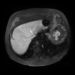 Acute cholecystitis complicated by pylephlebitis (Radiopaedia 65782-74915 Axial arterioportal phase T1 C+ fat sat 14).jpg