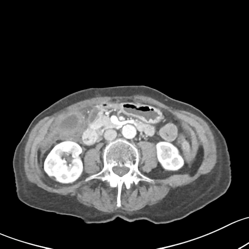 Acute cholecystitis with contained perforation (Radiopaedia 47328-51907 Axial C+ portal venous phase 36).png