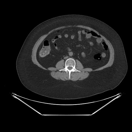 File:Acute cholecystitis with tensile fundus sign (Radiopaedia 71394-81723 Axial non-contrast 53).jpg