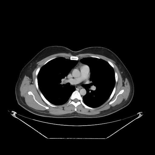 File:Acute complicated calculous cholecystitis (Radiopaedia 55202-61587 Axial C+ delayed 2).jpg