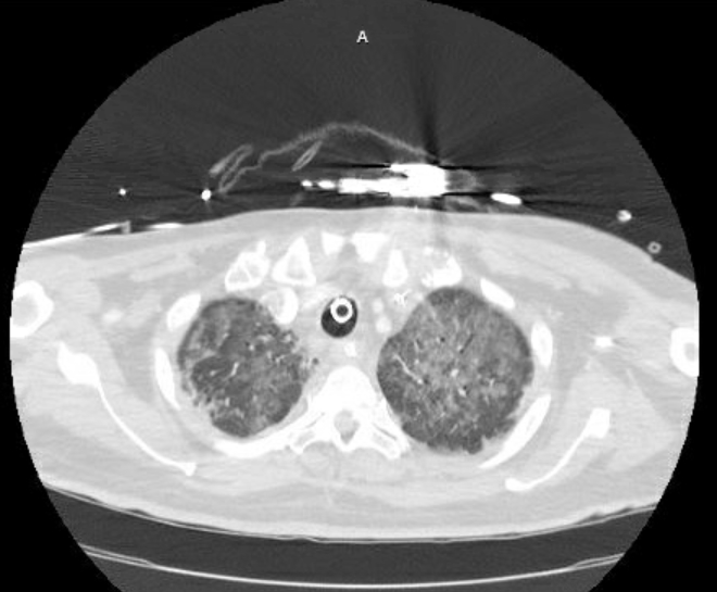Acute cor pulmonale (ultrasound) (Radiopaedia 83508-98818 Axial lung window 15).jpg
