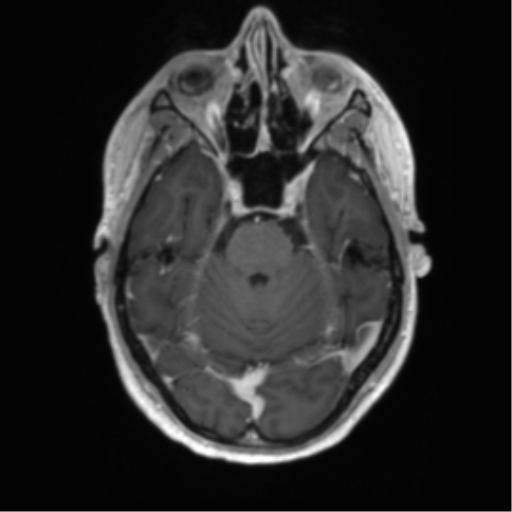 Acute disseminated encephalomyelitis (ADEM) (Radiopaedia 65319-74350 Axial T1 C+ 15).png