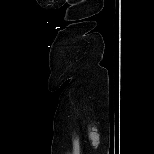 Acute diverticulitis - transverse colon (Radiopaedia 87063-103327 Sagittal C+ portal venous phase 211).jpg