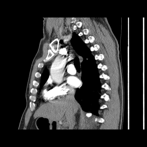 Acute epicardial fat necrosis (Radiopaedia 42327-45440 Sagittal C+ CTPA 33).jpg