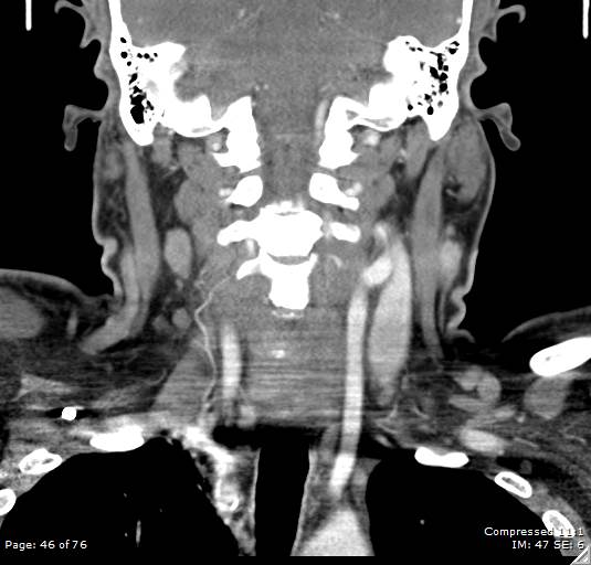 Acute epiglottitis (Radiopaedia 54375-60590 Coronal C+ arterial phase 46).jpg