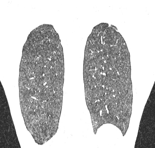 File:Acute hypersensitivity pneumonitis (Radiopaedia 85293-100870 Coronal lung window 115).jpg