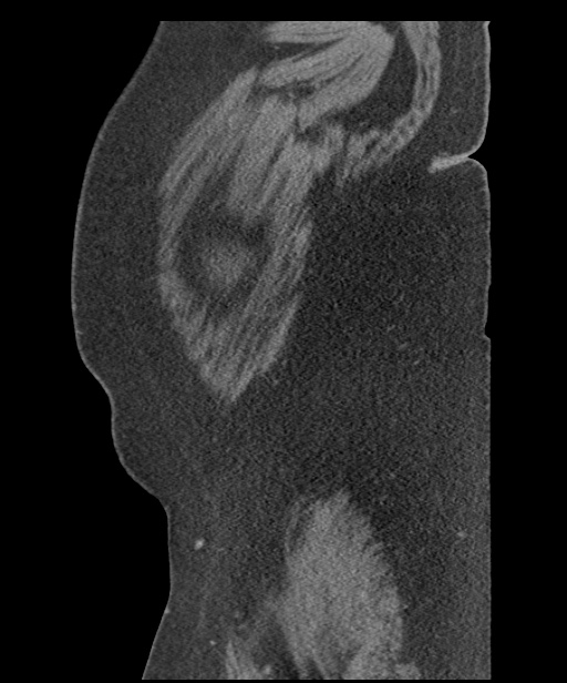 Acute mesenteric venous ischemia (Radiopaedia 46041-50383 Sagittal C+ portal venous phase 4).jpg