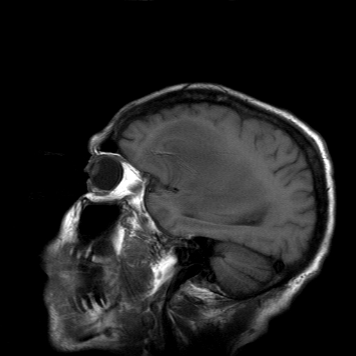 File:Acute necrotizing toxoplasma encephalitis (Radiopaedia 10683-11149 Sagittal T1 fat sat 5).jpg